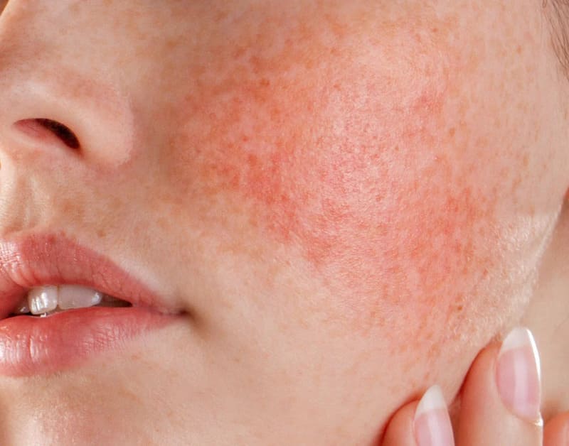 cách chọn kem dưỡng ẩm cho da nhạy cảm