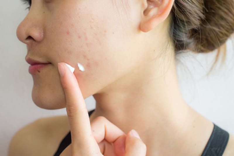 Da mụn có nên dùng kem dưỡng ẩm