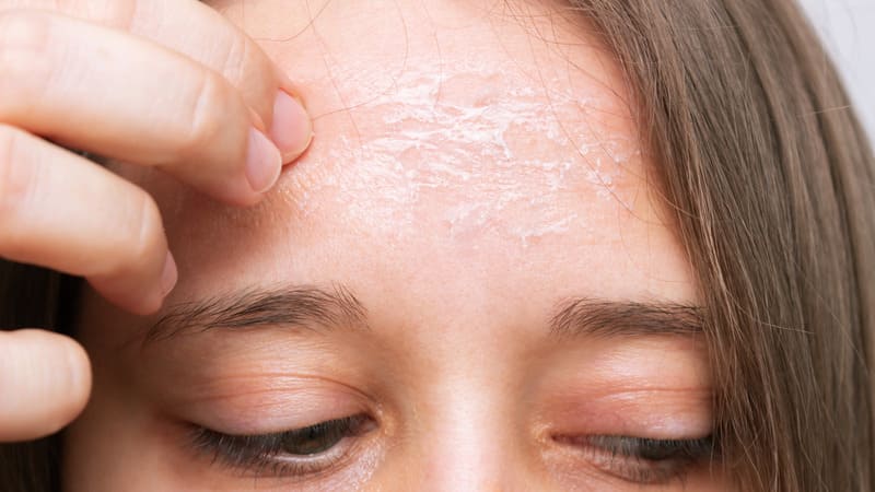 Đặc điểm của da khô