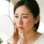 dị ứng kem chống nắng