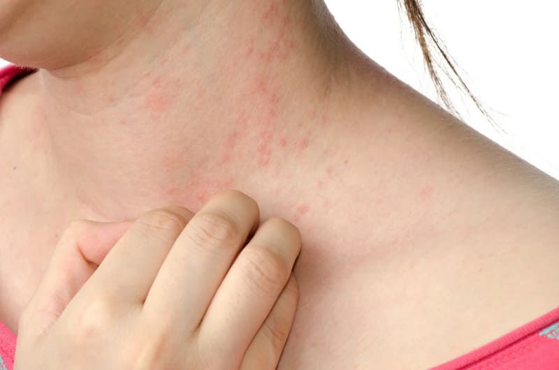 Các loại dị ứng kem chống nắng thường gặp