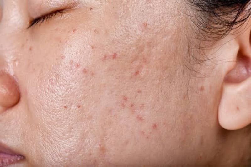 Đặc điểm da dầu