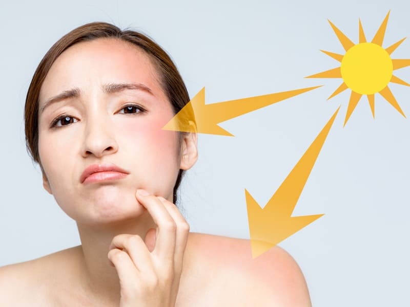 Tuổi dậy thì có nên dùng kem chống nắng không?