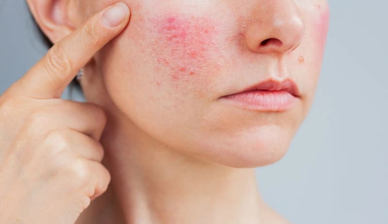 đắp mặt nạ giúp giảm viêm